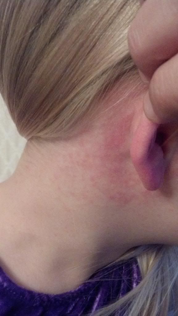 What are the possible causes of a rash behind the ears?